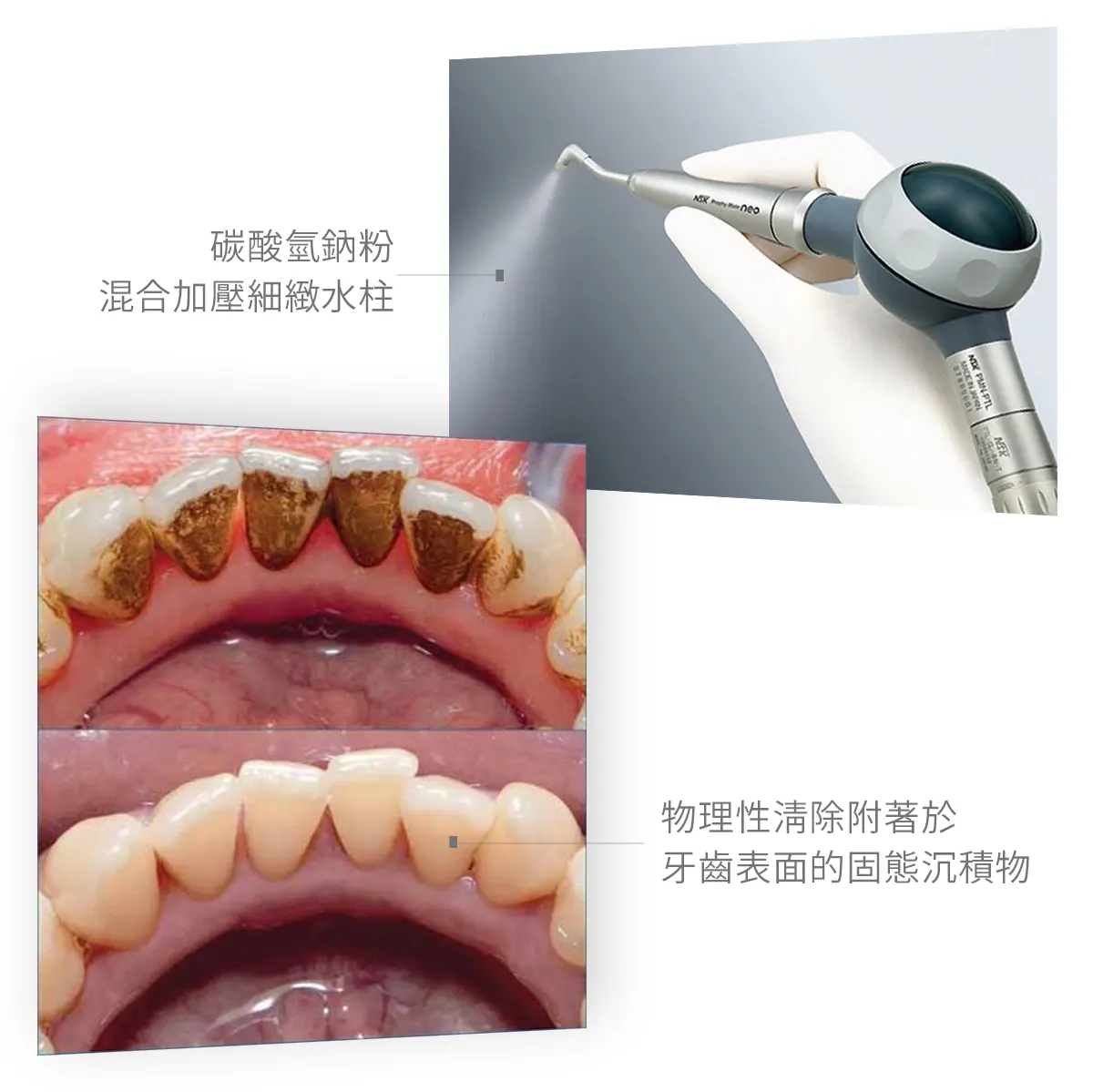 台中南投生活牙醫牙齒噴砂清潔色素沉積示意